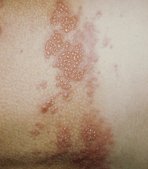 Infecciones de la piel HERPES Tratamiento BOGOTÁ