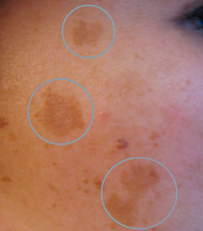 Melasma tratamiento manchas Bogotá