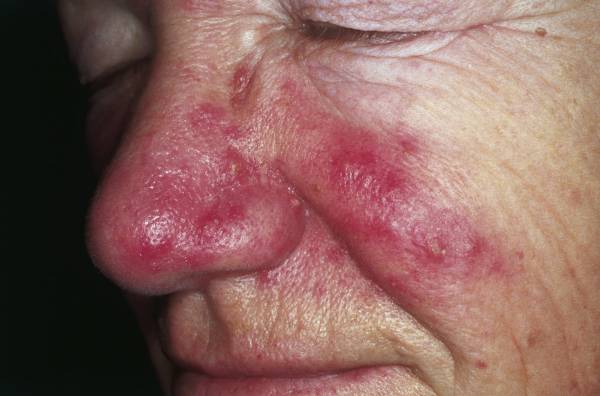 Rosacea tratamiento en Bogotá
